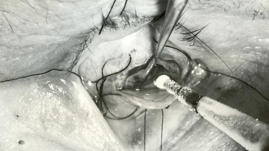 Operacja chirurgiczna oczu