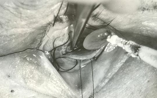 Operacja chirurgiczna oka dawnymi narzędziami