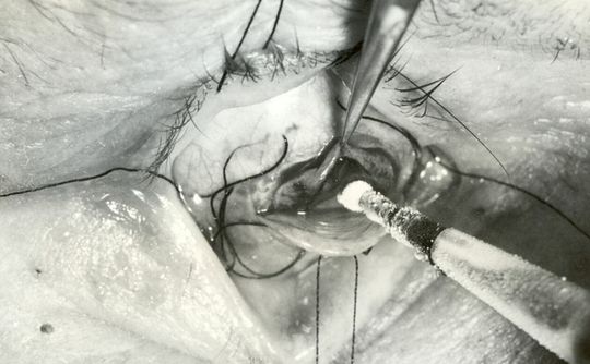 Operacja chirurgiczna oczu